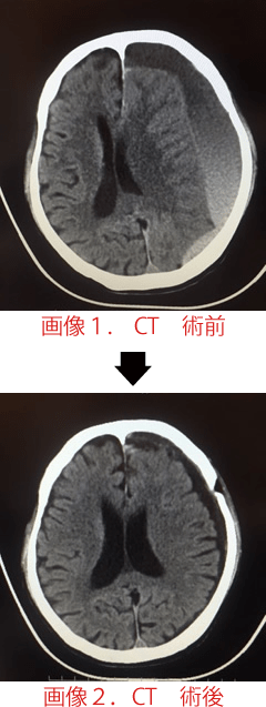 不明 何 日 出血 意識 くも膜 下